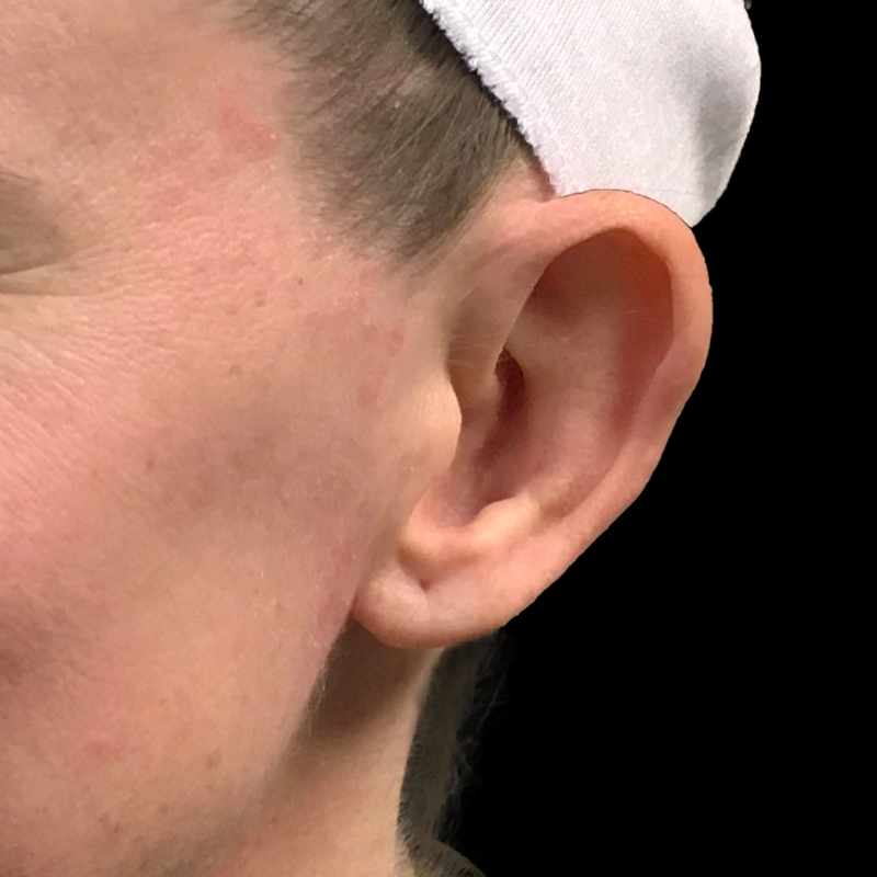 Otoplasty 05