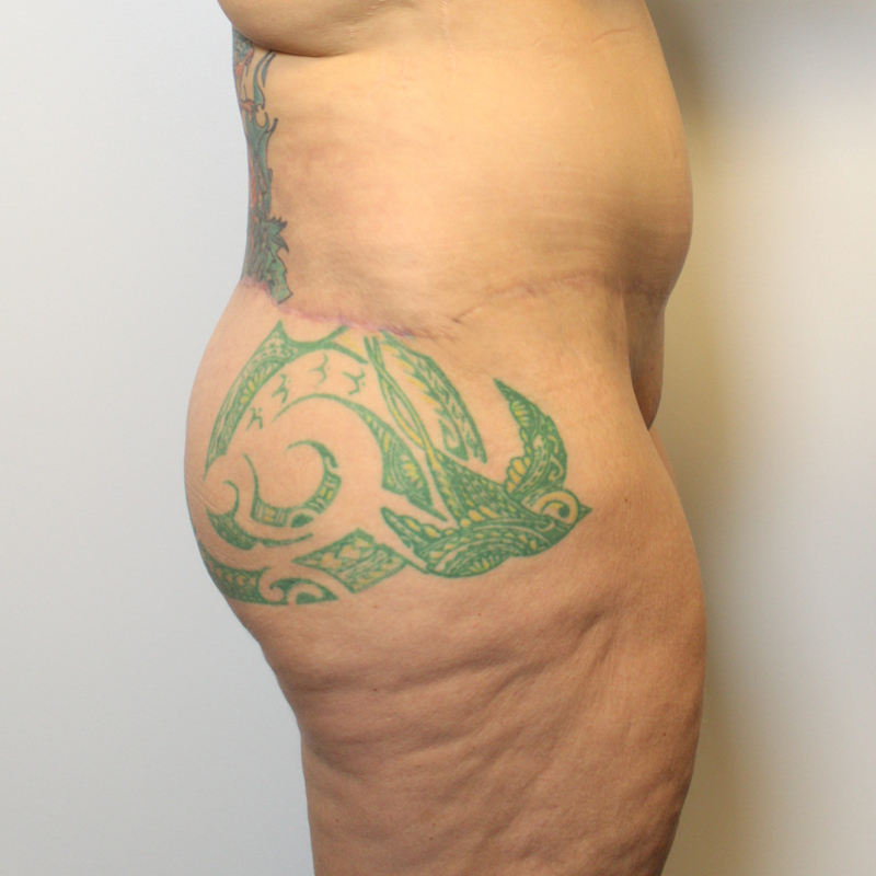 Posterior Body Lift 03