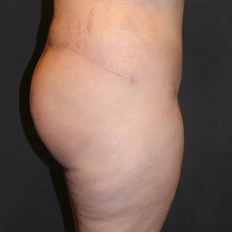 Posterior Body Lift 03