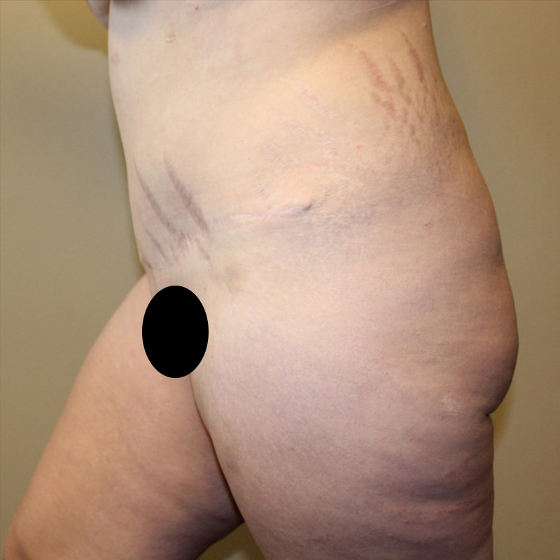 Posterior Body Lift 07