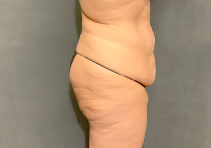 Posterior Body Lift 01