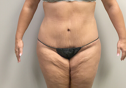 Posterior Body Lift 03