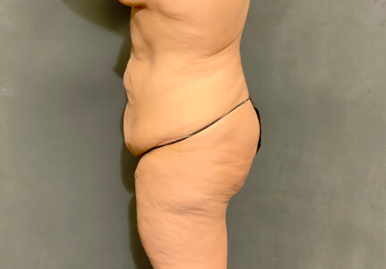 Posterior Body Lift 05