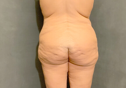 Posterior Body Lift 07