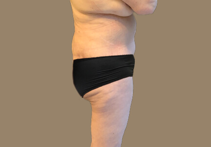 Posterior Body Lift 01