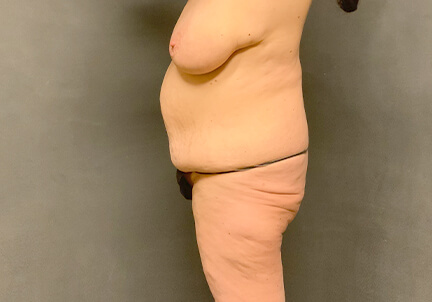 Posterior Body Lift 03