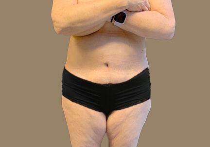 Posterior Body Lift 05