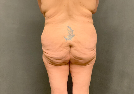 Posterior Body Lift 07