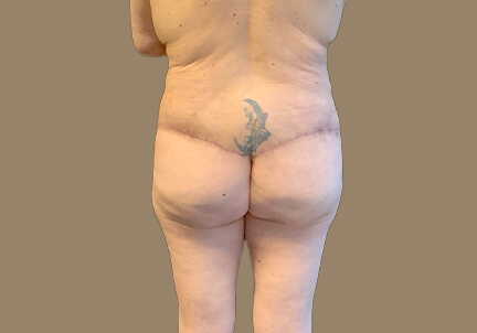 Posterior Body Lift 07