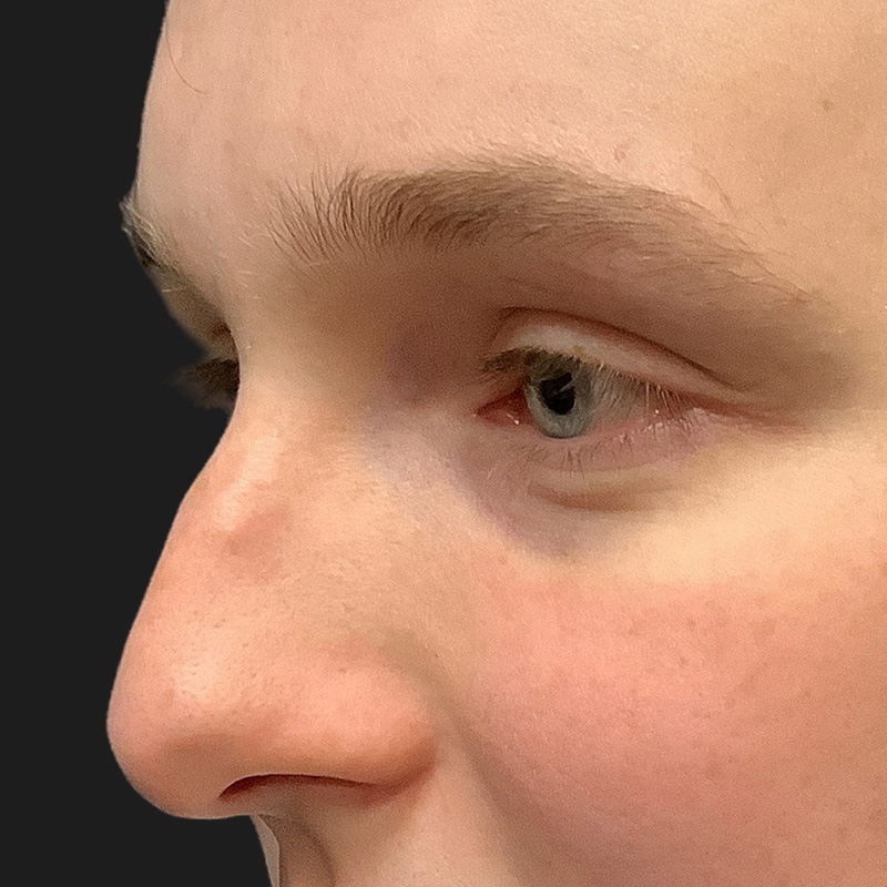 Rhinoplasty 01