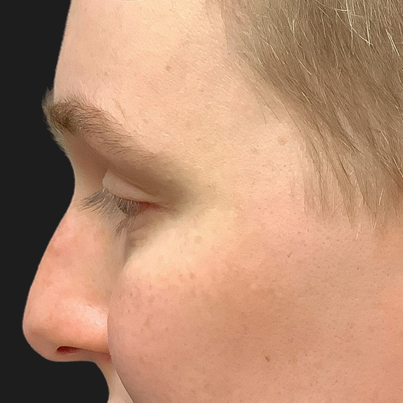 Rhinoplasty 03