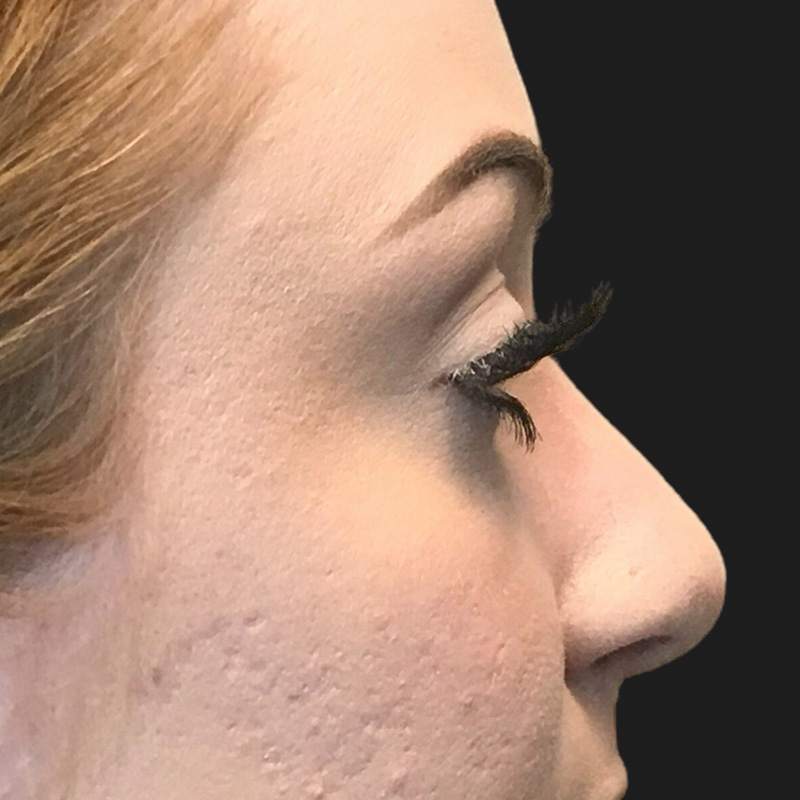Rhinoplasty 06