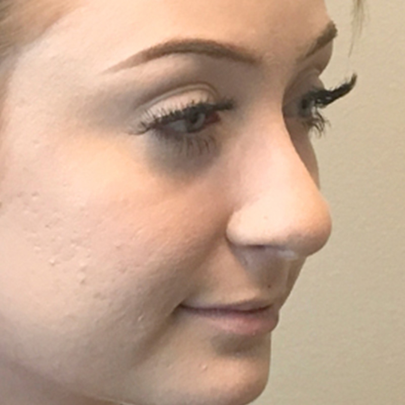Rhinoplasty 03