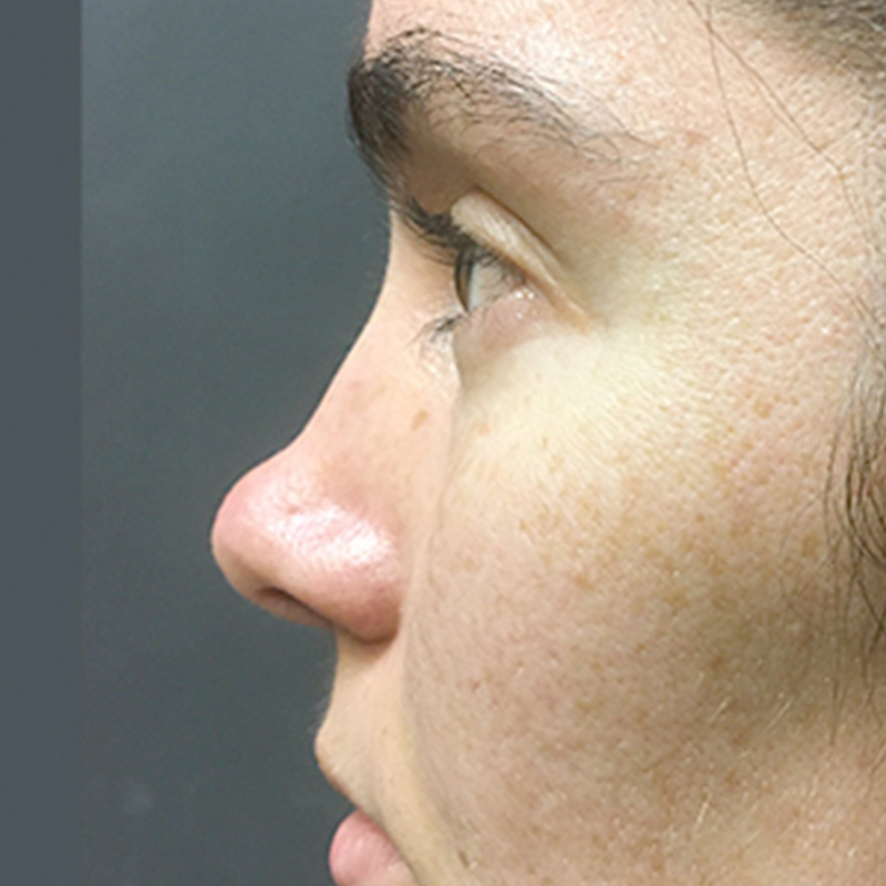 Rhinoplasty 01