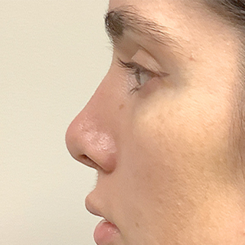 Rhinoplasty 11