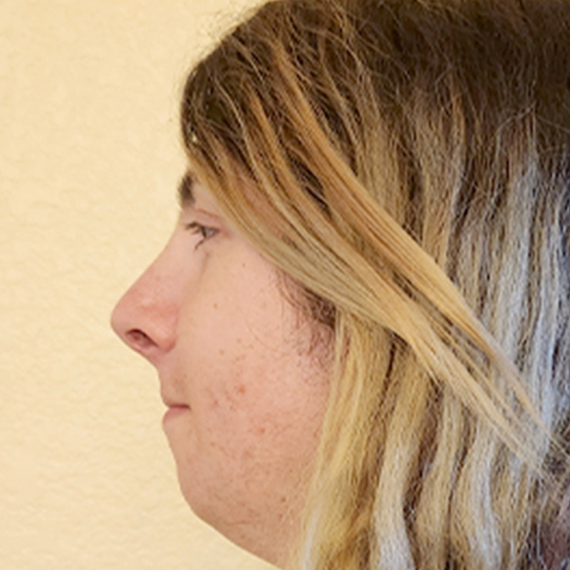 Rhinoplasty 09