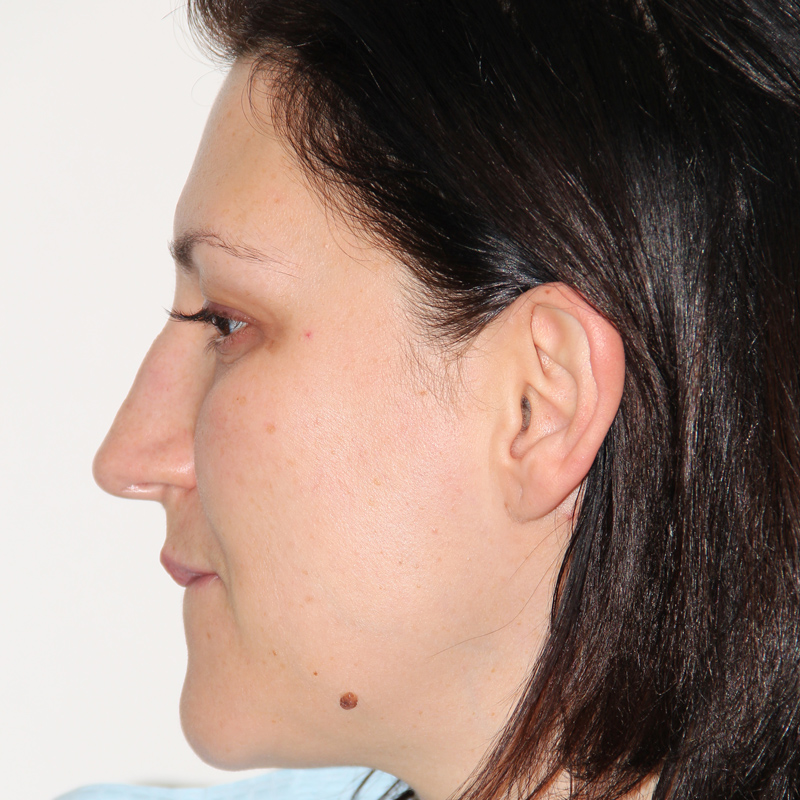 Rhinoplasty 03