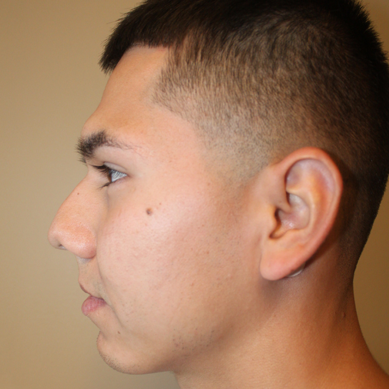 Rhinoplasty 05
