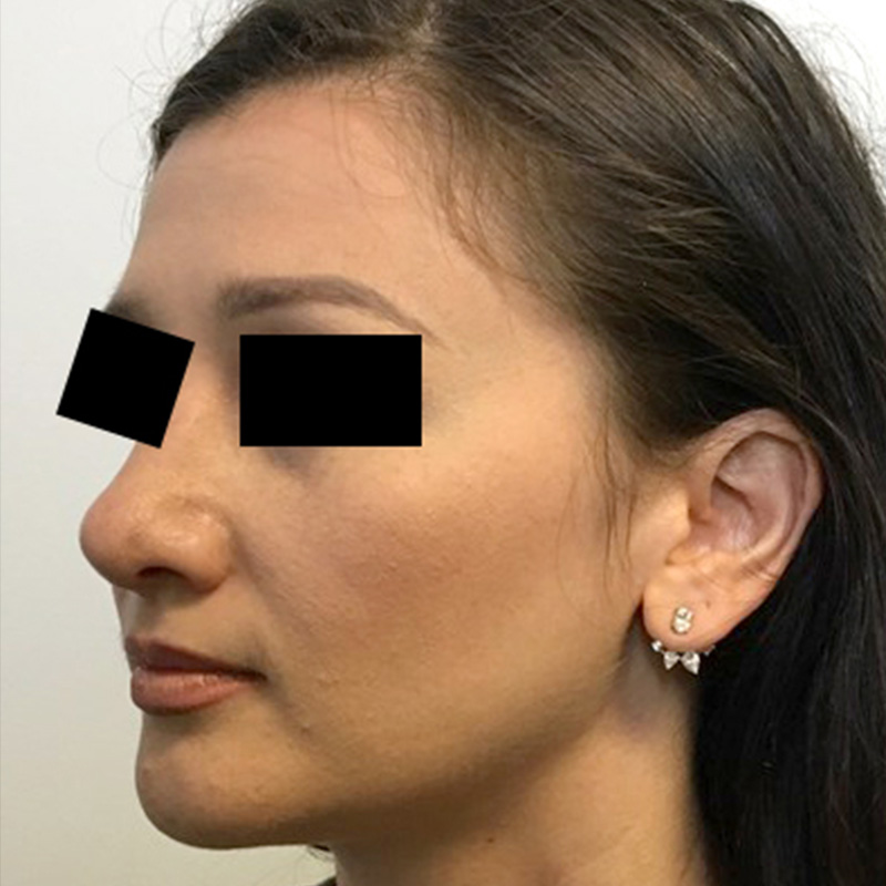 Rhinoplasty 17