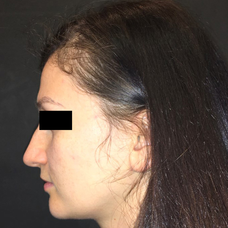 Rhinoplasty 05