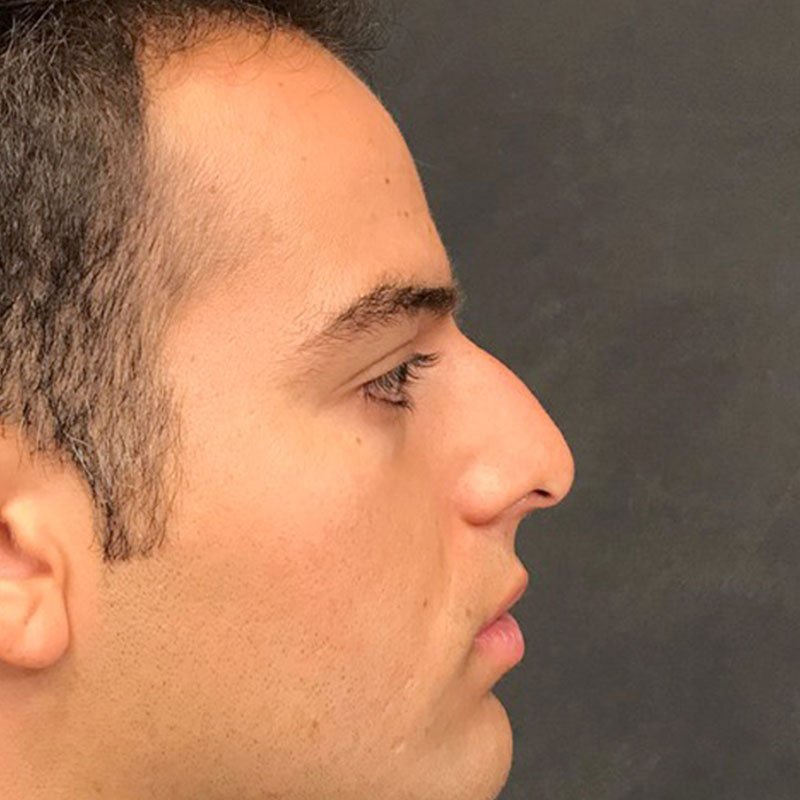 Rhinoplasty 05