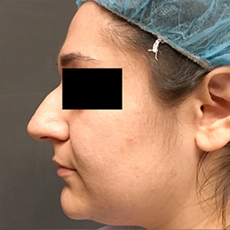 Rhinoplasty 01