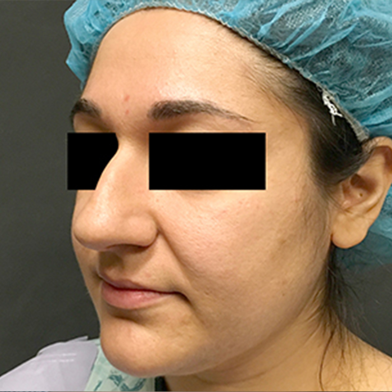 Rhinoplasty 03