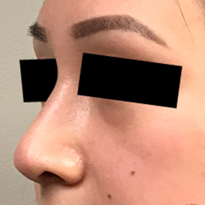 Rhinoplasty 05