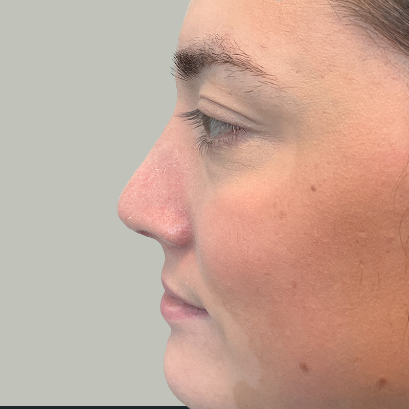 Rhinoplasty 15