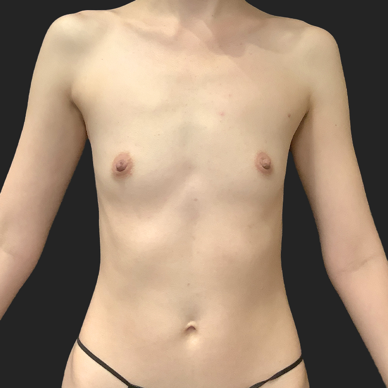 Transaxillary Breast Augmentation 01