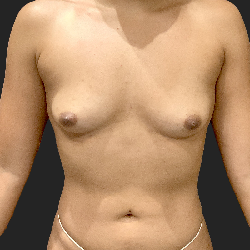 Transaxillary Breast Augmentation 01