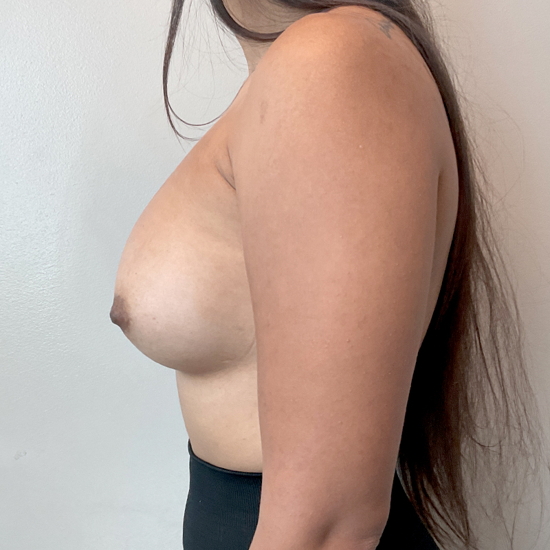 Transaxillary Breast Augmentation 05