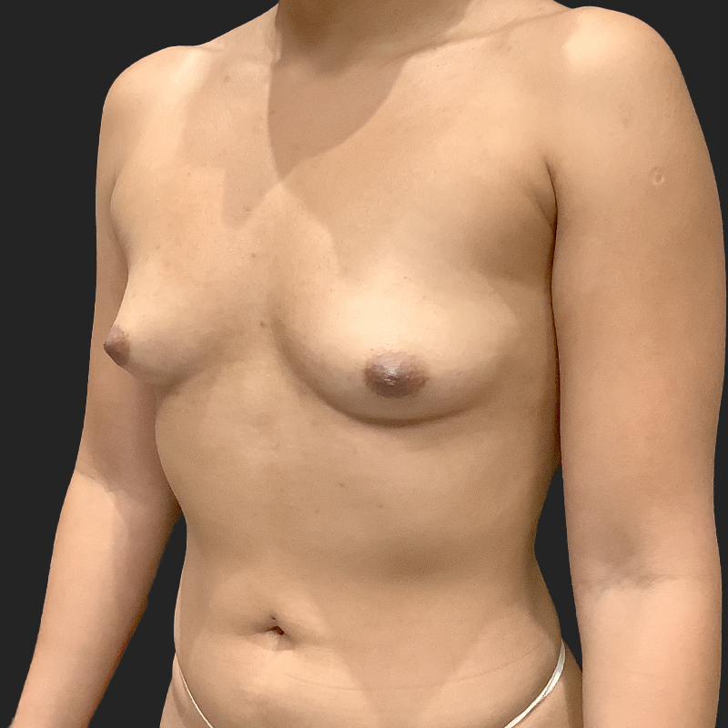 Transaxillary Breast Augmentation 09