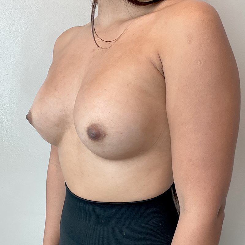 Transaxillary Breast Augmentation 09