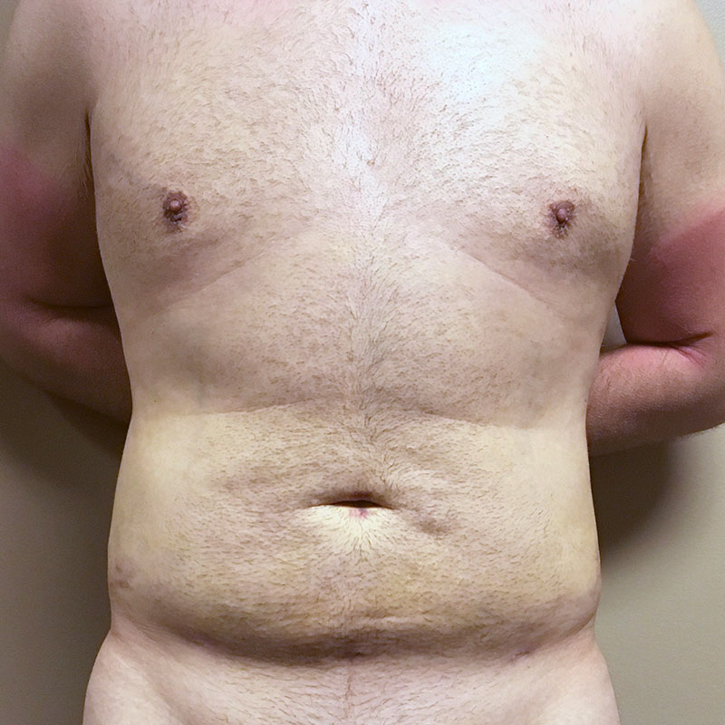 Vaser Liposuction 01