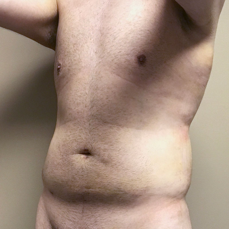 Vaser Liposuction 03