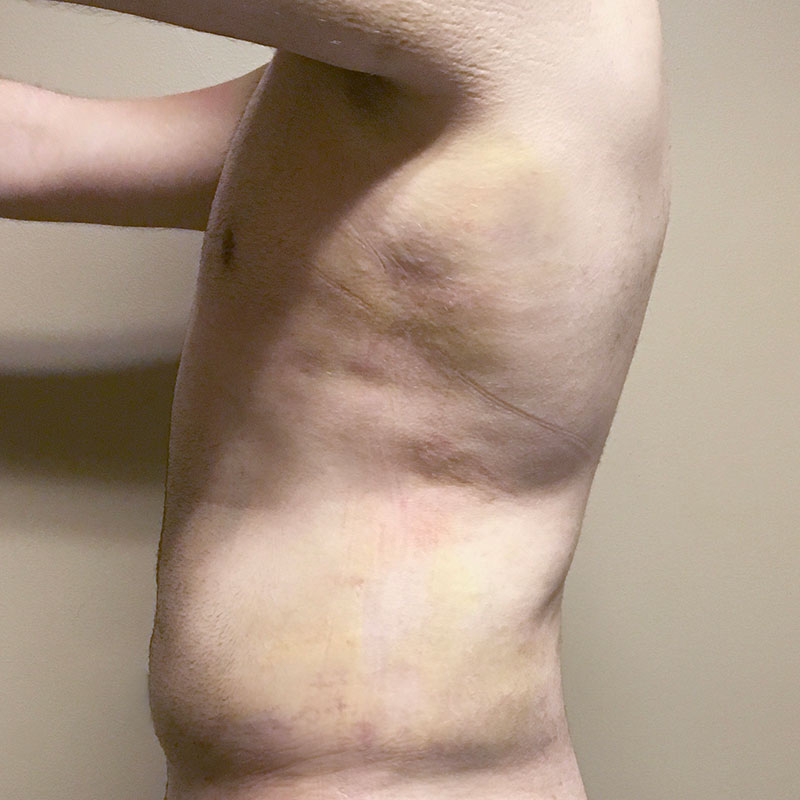 Vaser Liposuction 05