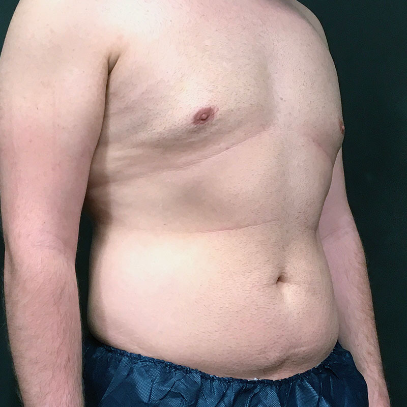 Vaser Liposuction 07