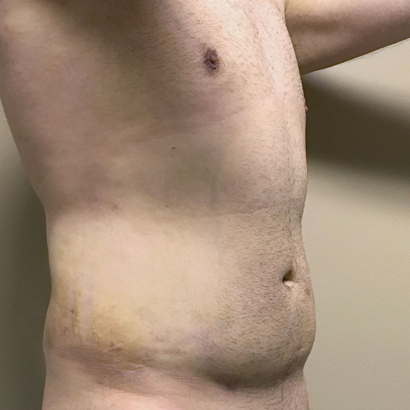 Vaser Liposuction 07