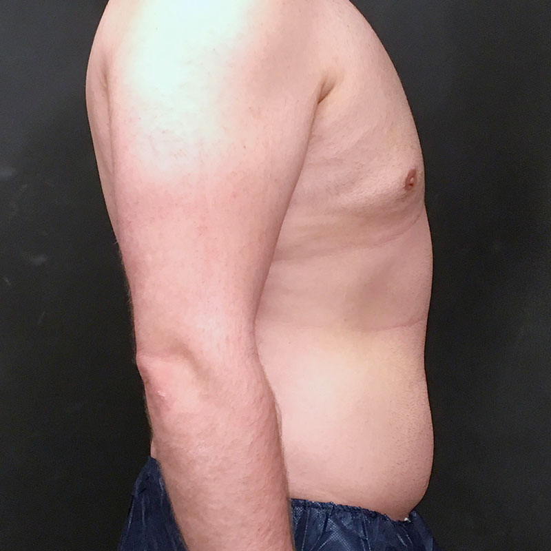 Vaser Liposuction 09