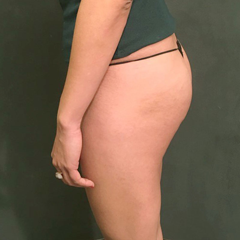 Zombie Brazilian Butt Lift 03