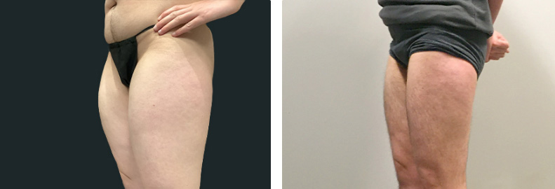 FTM Body Contouring Before After 01