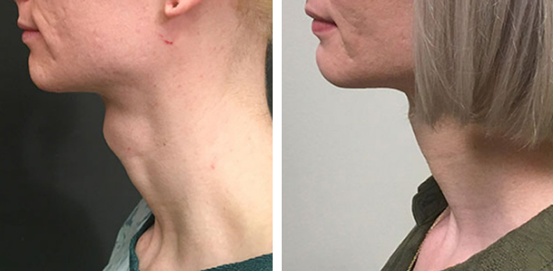 Tracheal Shave Before After 02