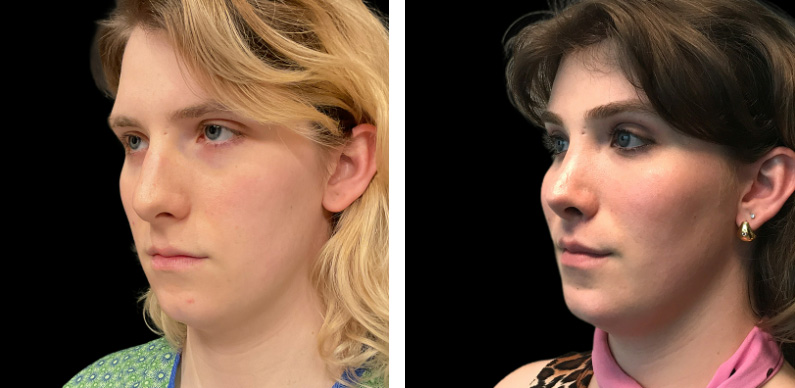 Transgender Rhinoplasty Before After