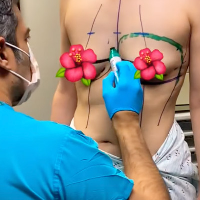 Breast Augmentation to Correct Asymmetrical Breasts!