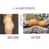 Best Seattle Brazilian Butt Lift Liposuction