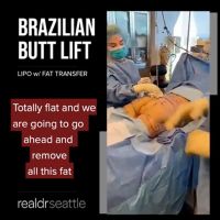 The Best Brazilian Butt Lift in Washington State by the Dr. Seattle