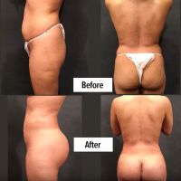 Brazilian Butt Lift How Big Can you Go with a BBL and Liposuction