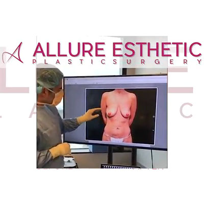 Breast Augmentation with Lift