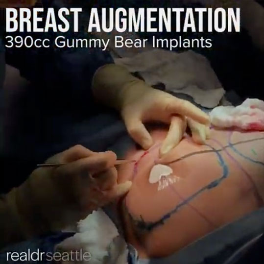 Seattle Breast Augmentation (Boob Job) Gummy Bear Implants